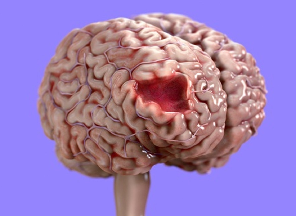 गंभीर संक्रमण