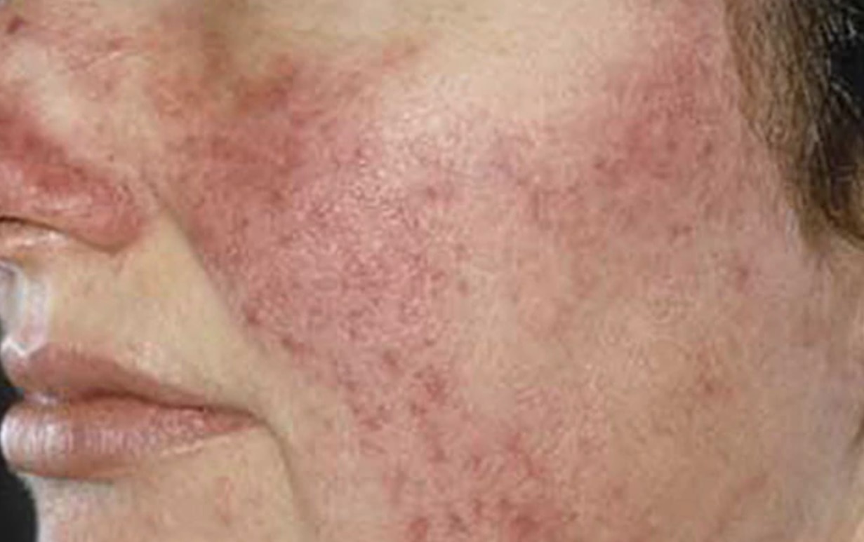 हाई ब्लड प्रेशर 4