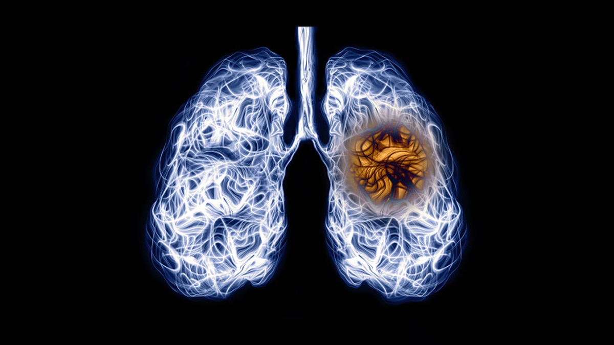 World Tuberculosis Day 2021