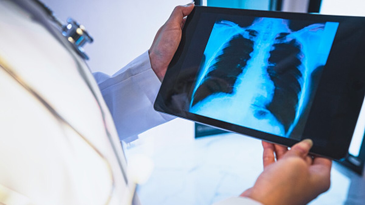 टीबी का इलाज