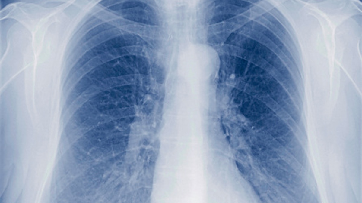  टीबी बैक्टीरिया