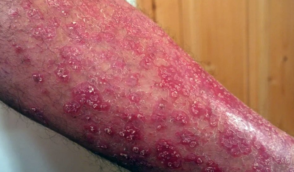 कोरोना वायरस की दूसरी लहर3