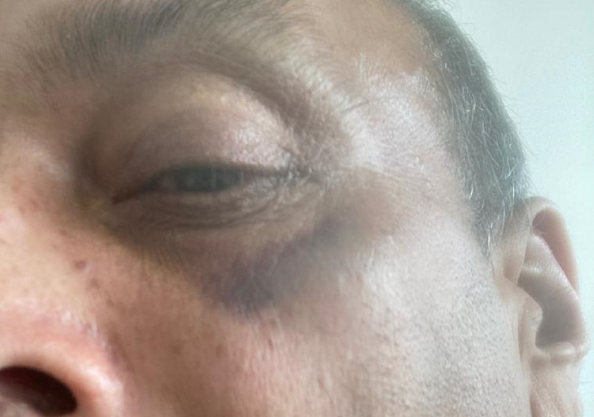 अस्पताल में मेहुल चोकसी