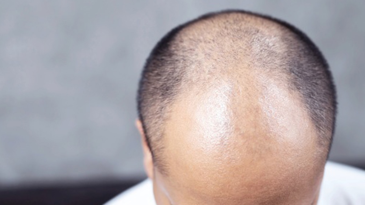 पुरुषों में हेयर लॉस