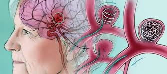 ब्रेन एन्यूरिज्म