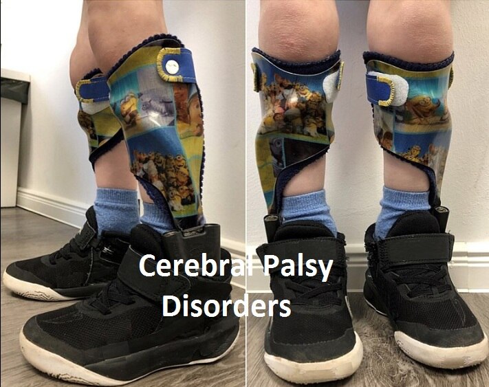 सेरेब्रल पाल्सी
