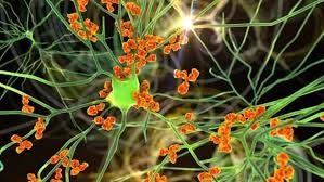 गुलेनबेरी सिंड्रोम