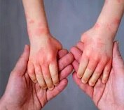 टोमैटो फीवर