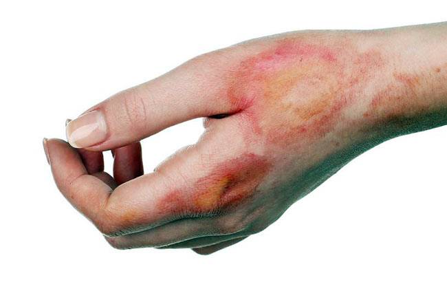 घरेलू उपचार अपनाने से पहले एक बार ये भी जानें...