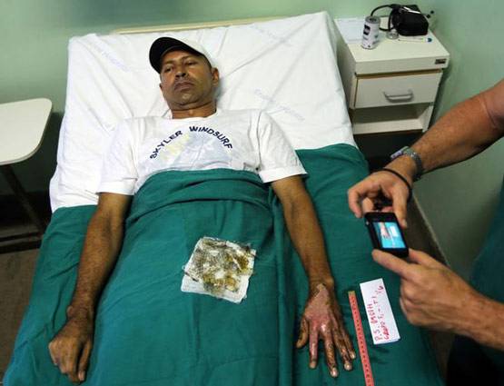 जले लोगों के ऊपर लगाते हैं मछली की स्किन, इस तरह डॉक्टर कर रहे इलाज