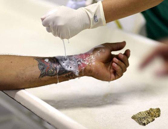 जले लोगों के ऊपर लगाते हैं मछली की स्किन, इस तरह डॉक्टर कर रहे इलाज