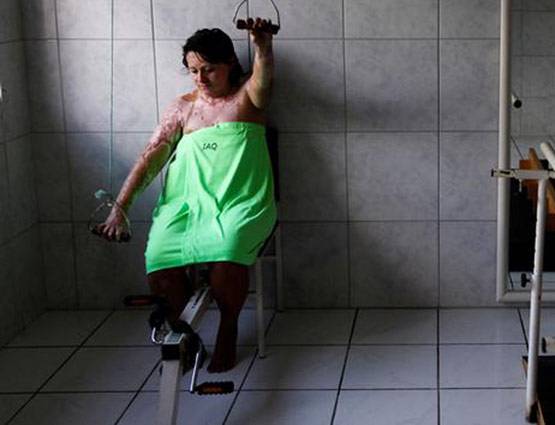 जले लोगों के ऊपर लगाते हैं मछली की स्किन, इस तरह डॉक्टर कर रहे इलाज