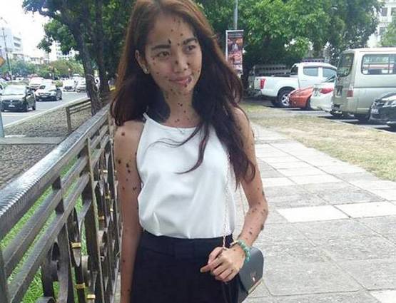 शरीर पर बड़े मस्सों के साथ पैदा हुई लड़की ने दिया मिस यूनिवर्स ऑडिशन