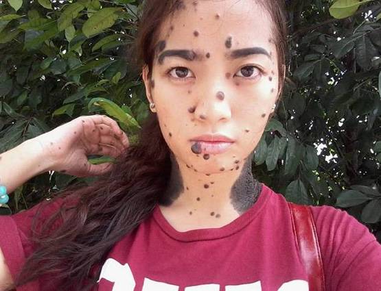 शरीर पर बड़े मस्सों के साथ पैदा हुई लड़की ने दिया मिस यूनिवर्स ऑडिशन