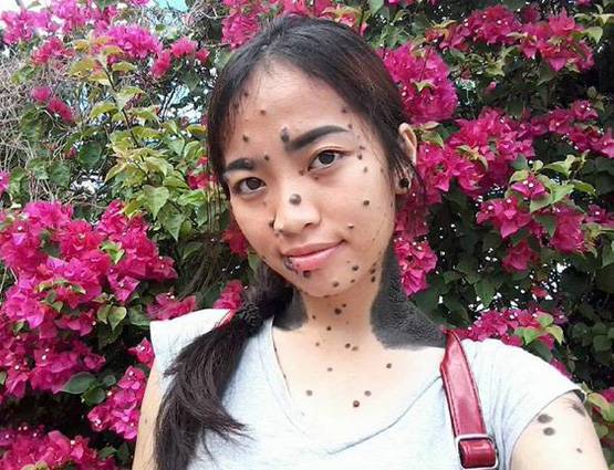 शरीर पर बड़े मस्सों के साथ पैदा हुई लड़की ने दिया मिस यूनिवर्स ऑडिशन