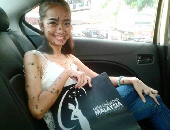 शरीर पर बड़े मस्सों के साथ पैदा हुई लड़की ने दिया मिस यूनिवर्स ऑडिशन