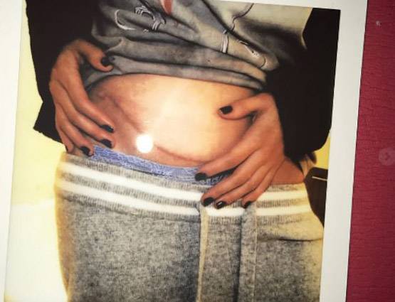 बेस्ट फ्रेंड ने किडनी देकर बचाई इस पॉप स्टार की जान