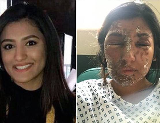 एसिड अटैक में बिगड़ चुकी थी सूरत, रिकवरी के बाद की फोटो वायरल