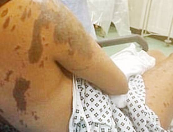 एसिड अटैक में बिगड़ चुकी थी सूरत, रिकवरी के बाद की फोटो वायरल