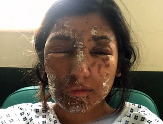 एसिड अटैक में बिगड़ चुकी थी सूरत, रिकवरी के बाद की फोटो वायरल