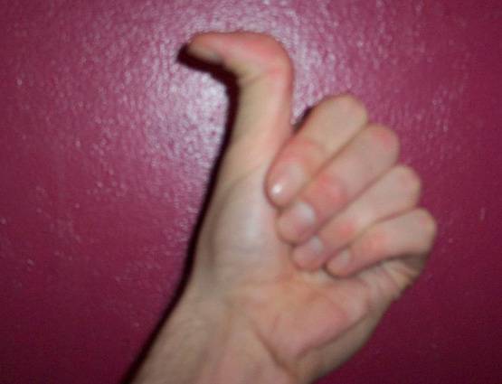 क्या आपका भी अंगूठा ऐसे मुड़ जाता है, जानिए मतलब