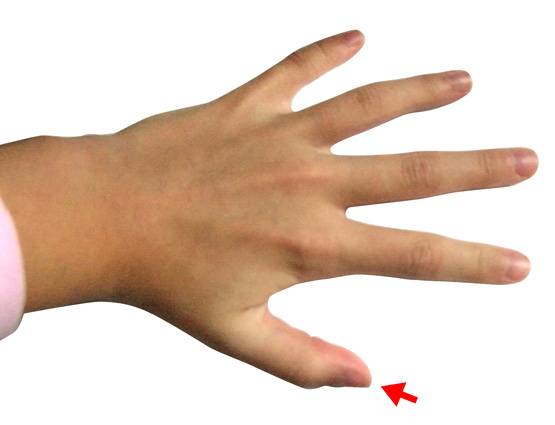 क्या आपका भी अंगूठा ऐसे मुड़ जाता है, जानिए मतलब