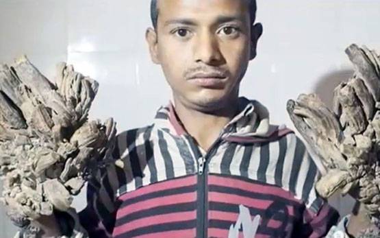 24 सर्जरी के बाद ठीक हुए थे, फिर हाथों में उगने लगे 'पेड़'