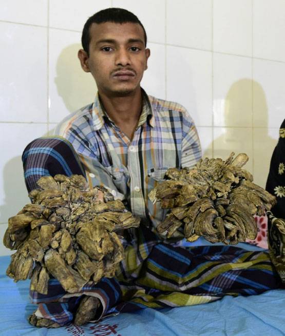 24 सर्जरी के बाद ठीक हुए थे, फिर हाथों में उगने लगे 'पेड़'