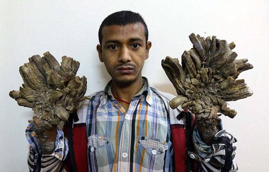 24 सर्जरी के बाद ठीक हुए थे, फिर हाथों में उगने लगे 'पेड़'