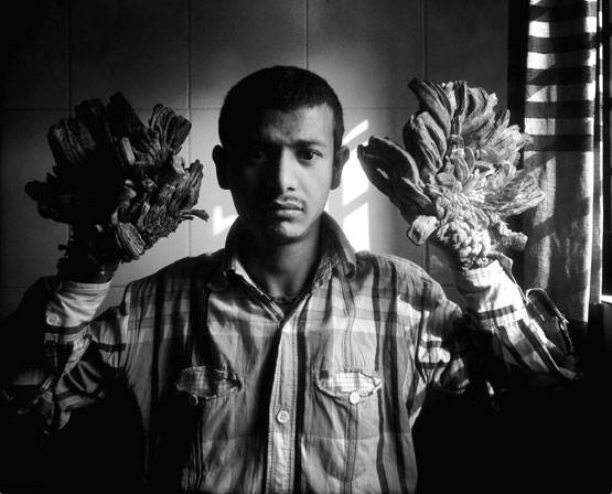 24 सर्जरी के बाद ठीक हुए थे, फिर हाथों में उगने लगे 'पेड़'