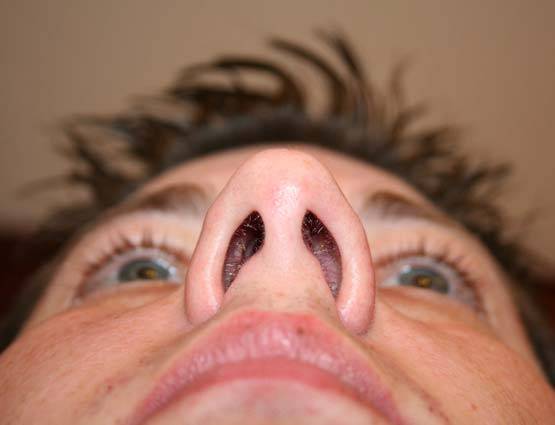 गर्मी में फूटती है नकसीर, करें ये आसान उपाय