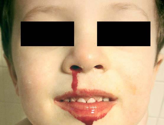 गर्मी में फूटती है नकसीर, करें ये आसान उपाय