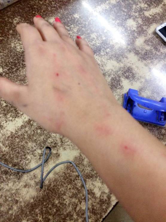 उबर कैब में 2 महिलाओं में मारपीट: पत्रकार के बाल खींचे, किया घायल