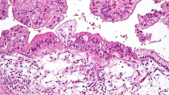 एक्ट्रेस सोनाली बेंद्रे को कैंसर, इन 7 चीजों से बढ़ता है खतरा