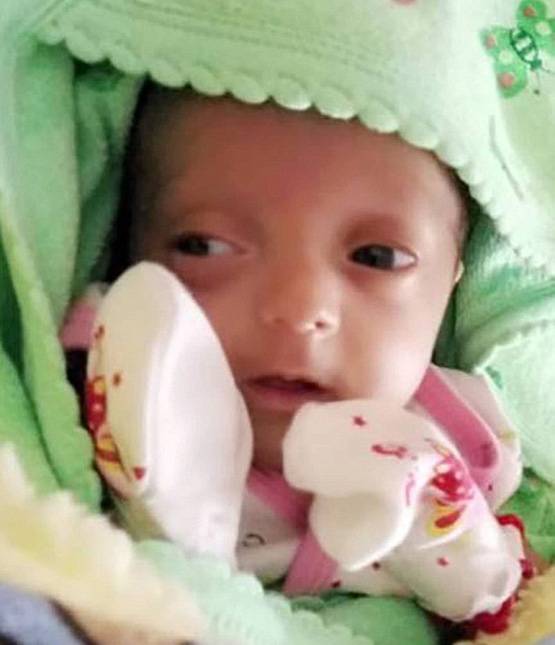 ये है भारत की सबसे छोटी बच्ची, वजन महज 375 ग्राम