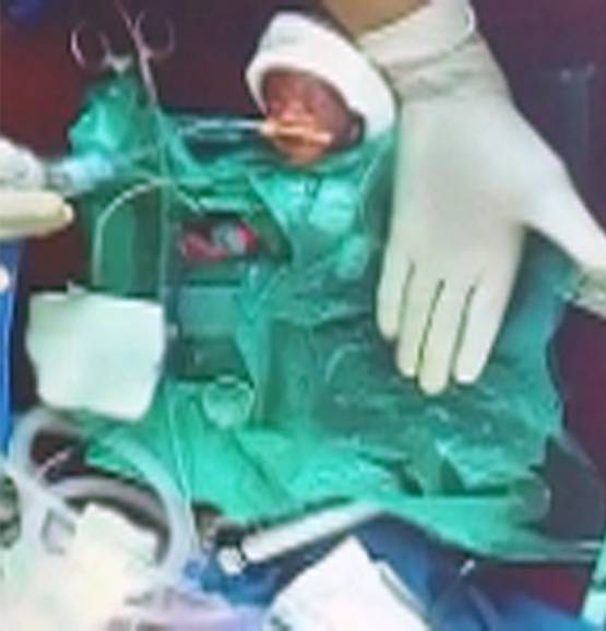 ये है भारत की सबसे छोटी बच्ची, वजन महज 375 ग्राम