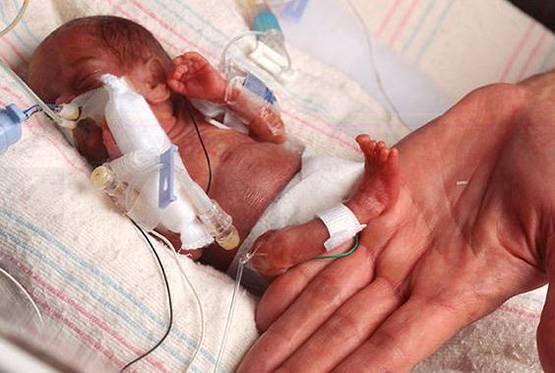 ये है भारत की सबसे छोटी बच्ची, वजन महज 375 ग्राम