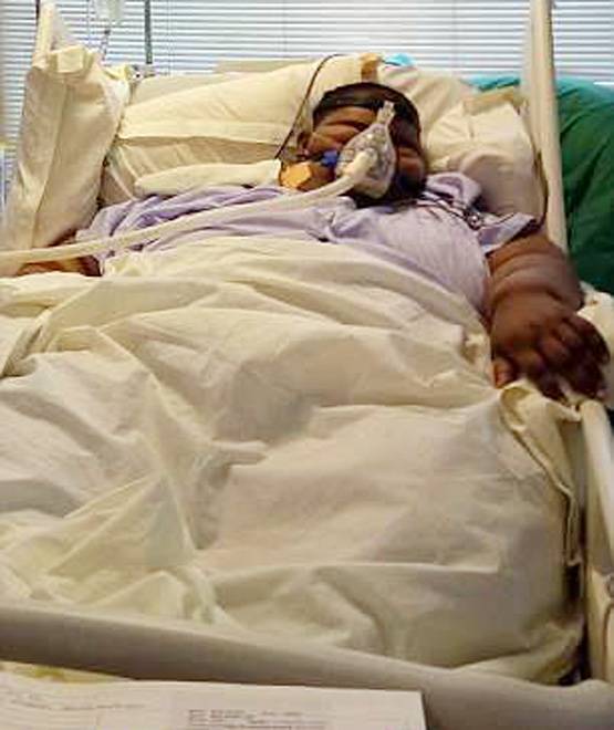 मिहिर दुनिया का सबसे मोटा बच्चा, 14 की उम्र में 237 Kg वजन!