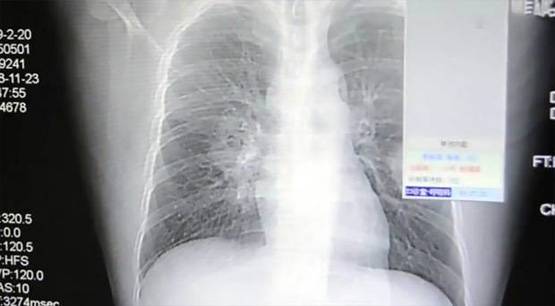 मोजा सूंघना पड़ा भारी, इस शख्स को हो गई ये खतरनाक बीमारी