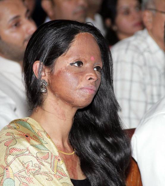 एसिड अटैक सर्वाइवर लक्ष्मी, जिसकी कहानी सुनकर रो पड़ी थीं दीपिका