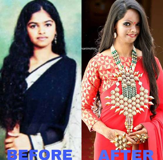 एसिड अटैक सर्वाइवर लक्ष्मी, जिसकी कहानी सुनकर रो पड़ी थीं दीपिका