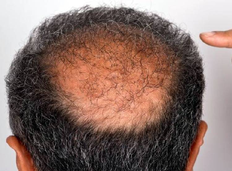 हेयर ट्रांसप्लांट के नाम पर ठग रहें लोग, टैक्सी ड्राइवर कर रहे सर्जरी