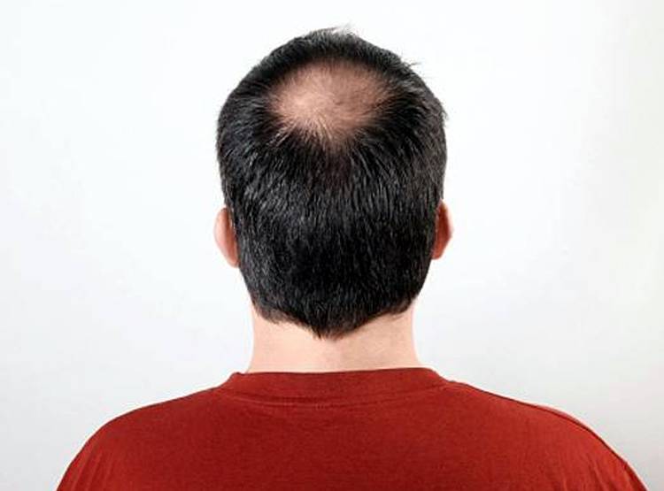 हेयर ट्रांसप्लांट के नाम पर ठग रहें लोग, टैक्सी ड्राइवर कर रहे सर्जरी