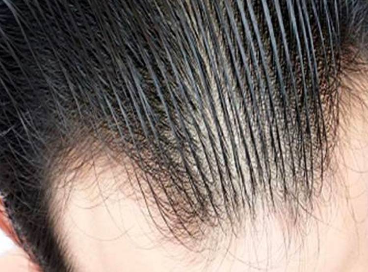 हेयर ट्रांसप्लांट के नाम पर ठग रहें लोग, टैक्सी ड्राइवर कर रहे सर्जरी