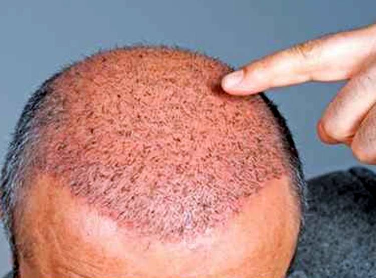 हेयर ट्रांसप्लांट के नाम पर ठग रहें लोग, टैक्सी ड्राइवर कर रहे सर्जरी