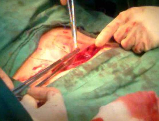 71 वर्षीय बुजुर्ग के पेट में था दर्द, सर्जरी में निकली 7 किलो की सिस्ट