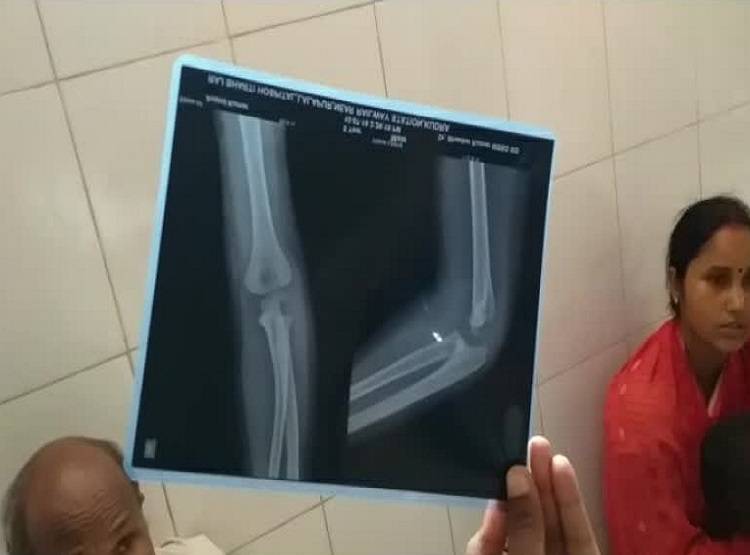 कैसे कहें डॉक्टर? टूटा हाथ छोड़कर दूसरे में चढ़ा दिया प्लास्टर