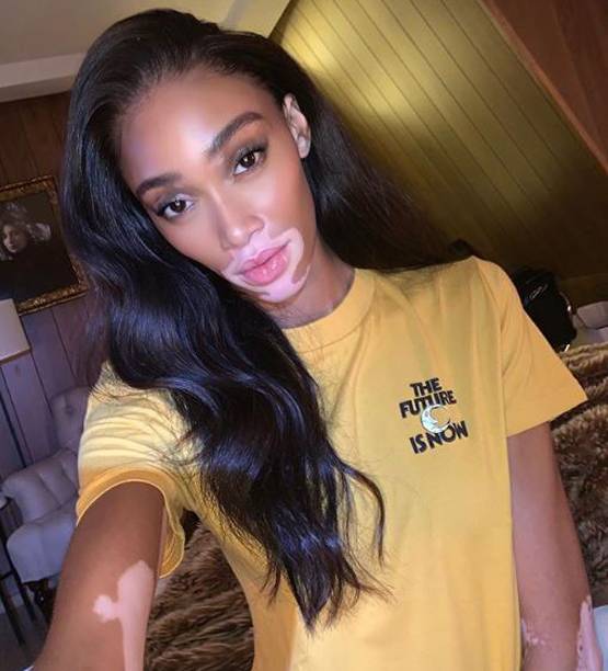 विनी हार्लो: चेहरे की वजह से बना मजाक, आज हैं ग्लोबल स्टार