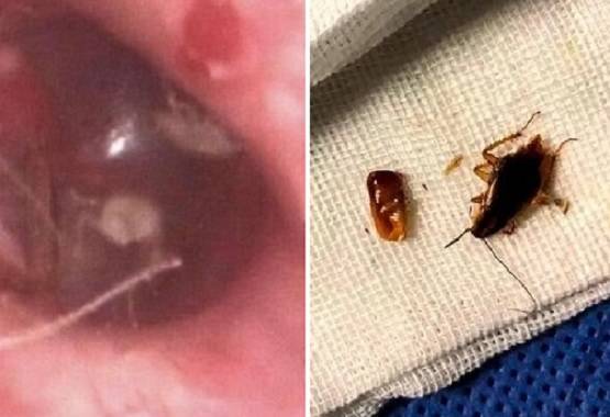 कान में हो रही थी खुजली, डॉक्टर ने देखा तो उड़े होश निकले 10 कॉकरोच