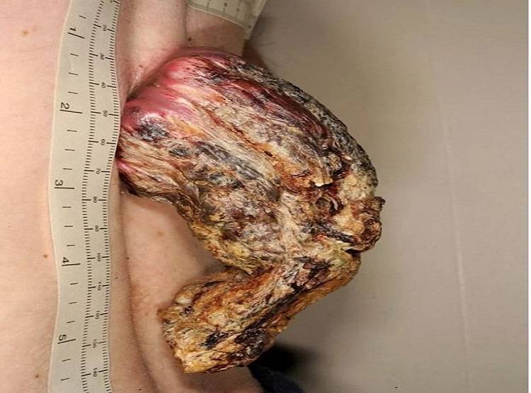 पीठ पर उग रहा था सींग, डॉक्टरों से चेक कराया तो उड़ गए होश